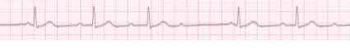 Figure 1. ECG lead II, 25mm/s.
