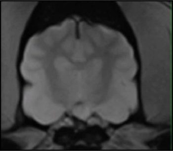 Figure 3d. Transverse images of the brain: gradient echo post-contrast showing a mass arising from the sella turcica. No evidence exists of haemorrhage on the gradient echo sequence.