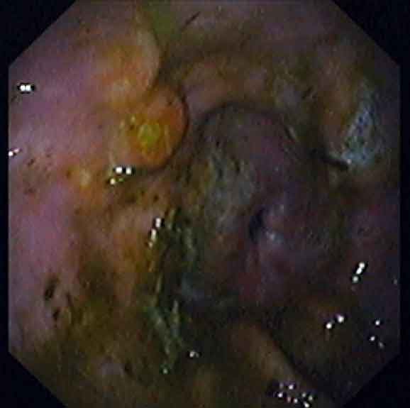 In this equine glandular gastric disease case, glandular erosions, hyperaemia and nodular thickening is evident.