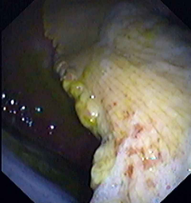 Small superficial ulcers are above the lesser curvature of the stomach in this case of equine squamous gastric disease.