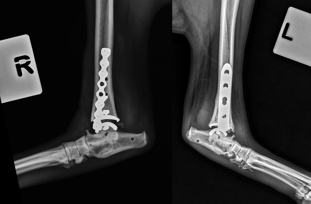 An x-ray showing both limbs following Vinny’s two BioMedtrix ankle replacements.
