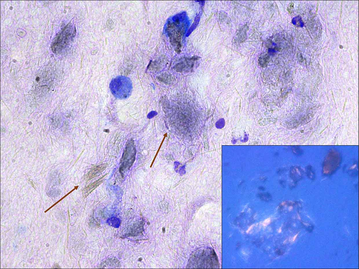 Figure 1. Hind leg lesion in a bearded dragon (fine needle aspirate; Wright-Giemsa 50×). (1a) Image obtained by lowering the microscope condenser. (1b) Image obtained by observing the preparation with polarised light microscope.