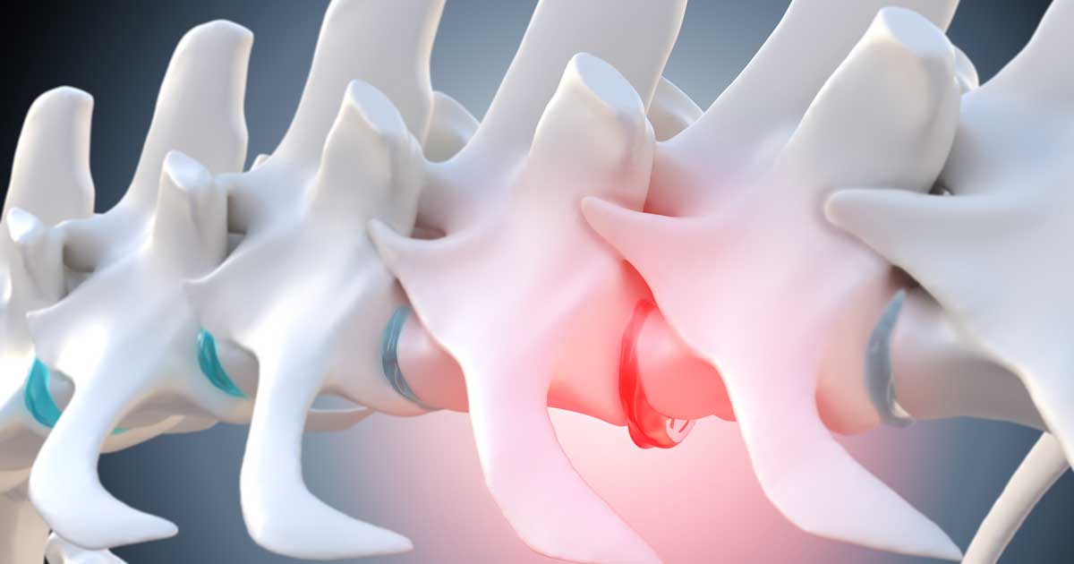 Degenerated intervertebral disc of the dog spine