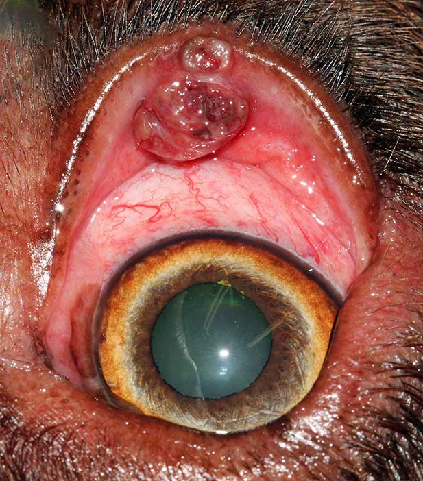 Figure 10. The everted upper eyelid reveals erupted meibomian gland epithelioma through the conjunctiva.