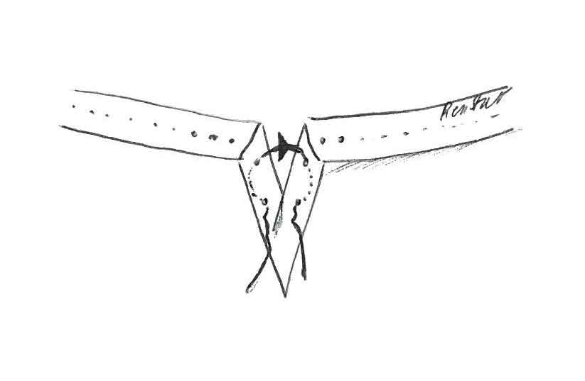 Figure 13a. The tarsal plate suture is buried within eyelid tissue following a far-near-across-near‑far suture pattern.