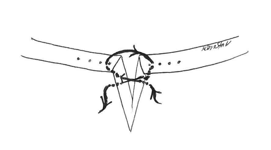 Figure 13b. The figure of eight suture: the needle is first placed in the skin away from the eyelid margin and directed obliquely to the other side of the defect to exit the eyelid margin through meibomian gland orifices, equidistant from the incision. The needle is then directed to the other side of the defect to enter the meibomian gland orifice equidistant from the incision. It is then directed to the other side of the wound, equidistant from the incision. After closure, the eyelid margin should be aligned precisely. The ends of the suture material can be caught in the knots of the adjacent simple, interrupted suture.