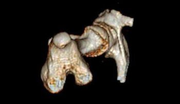 Figure 2. Volume rendered CT images used for measurements of femoral varus and anteversion angle (Ridge Referrals, South Devon).