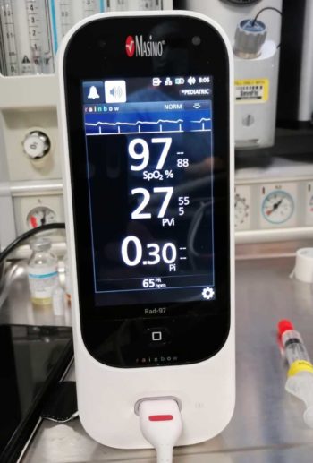 Pulse variability index before a crystalloid fluid challenge.