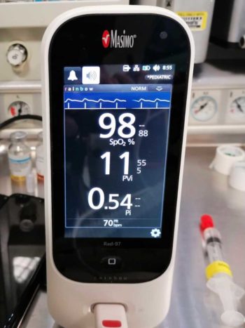 Pulse variability index after a crystalloid fluid challenge.