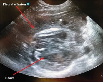Figure 1. Thoracic ultrasound showing echogenic pleural effusion next to the heart.