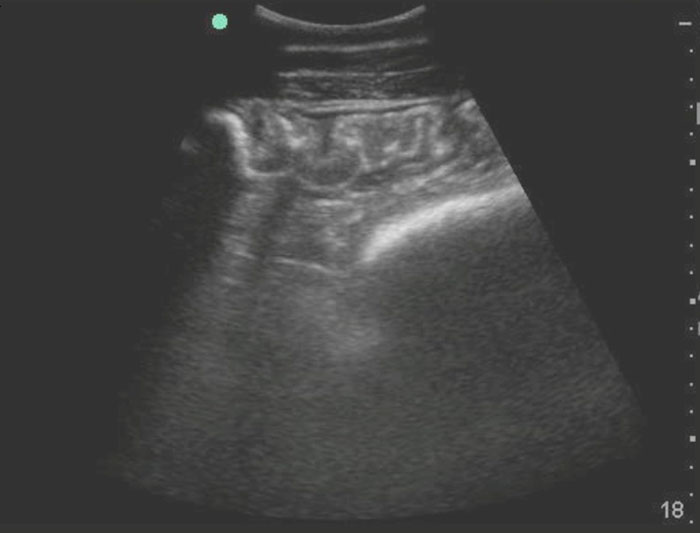 Figure 5. Ultrasound image from the cranioventral abdomen of a horse with cyathostomiasis. The intramural thickness of the ventral colon is significantly increased.