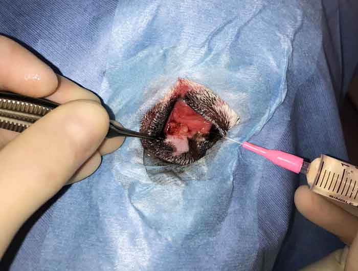 Figure 10. Clinical presentation of the meibomian gland adenoma involving the medial lower eyelid; lower eyelid punctum was visualised by flushing the upper eyelid punctum and it was repositioned medially.