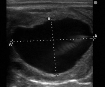 Figure 1. Ultrasound image of collapsing preovulatory follicle. Note the surrounding thickened granulosa cell layer. A = 4.55cm, B = 5.02cm.