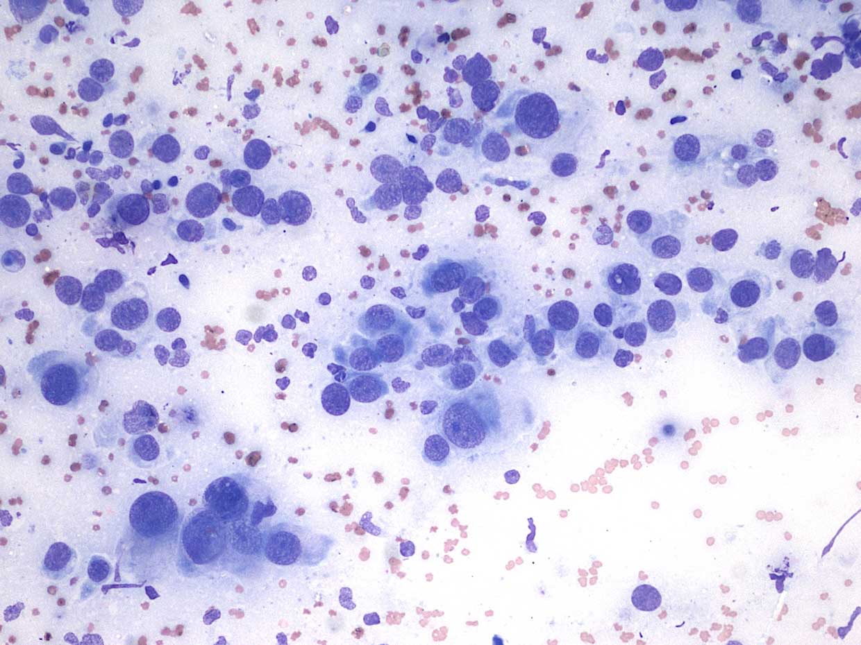 Interscapular mass in an adult domestic shorthair cat, fine needle aspirate (Wright-Giemsa, 20× to 50×).