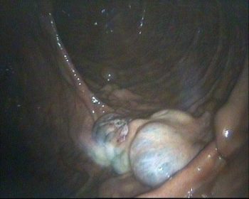 Figure 3. Hysteroscopic view of a group of endometrial cysts.