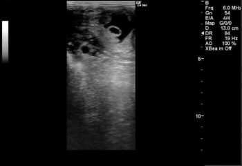 Figure 1. Ultrasonographic image of an endometrial cyst (in close apposition to a conceptus).