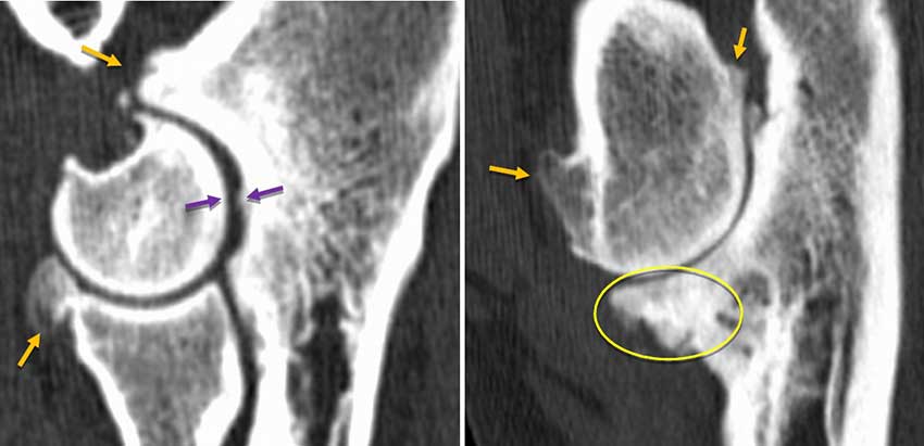 Figure 4. The CT of this elbow shows many of the changes commonly seen in elbow dysplasia: moderate incongruity with irregularity and sclerosis of the trochlear notch (purple arrows). The medial coronoid process of the ulna has marked osseous proliferation and deep fissure formation, which may represent a complete fracture with a large non-displaced fragment. The medial humeral epicondyle has bone spur formation (orange circles). Marked osteophytosis and enthesophytosis affects the anconeal process, olecranon, medial and lateral coronoid processes of the ulna, radial head and humeral epicondyles (orange arrows). But is this the “only” cause of the patient’s lameness? Image: VetCT