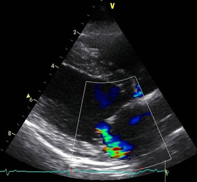 Figure 2. Right parasternal long-axis, four‑chamber view with colour flow Doppler showing a moderate mitral regurgitation jet projected towards the atrial free wall.