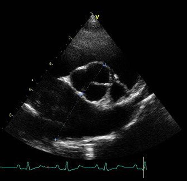 Figure 4. Right parasternal short axis view at the level of the aorta showing a normal left atrial size. Measurements were taken in early diastole – the frame after the aortic valve closes.