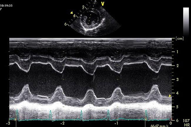 Figure 5. Right parasternal short axis view at the level of the ventricle – M mode.