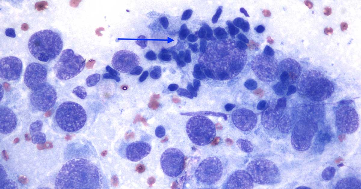 Interscapular mass in an adult domestic shorthair cat, fine needle aspirate (Wright-Giemsa, 20× to 50×).