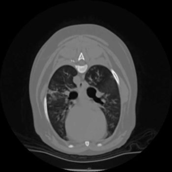 Figure 2. A cross-section of a CT of the lungs showing the marked patchy alveolar pattern present.