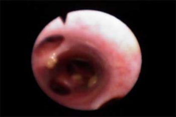 Figure 3. A still image of the large airways captured during bronchoscopy, which demonstrates the abundant mucopurulent discharge present.