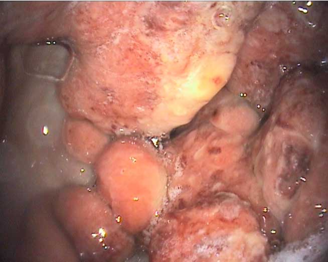 Equine glandular gastric disease is often more refractory to treatment than equine squamous gastric disease.