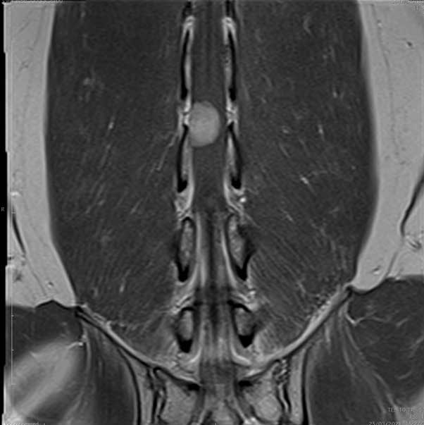 A T1-weighted post-contrast dorsal scan showing a uniform enhancement and smooth outline of the lesion on the left side adjacent to the exit foramina.