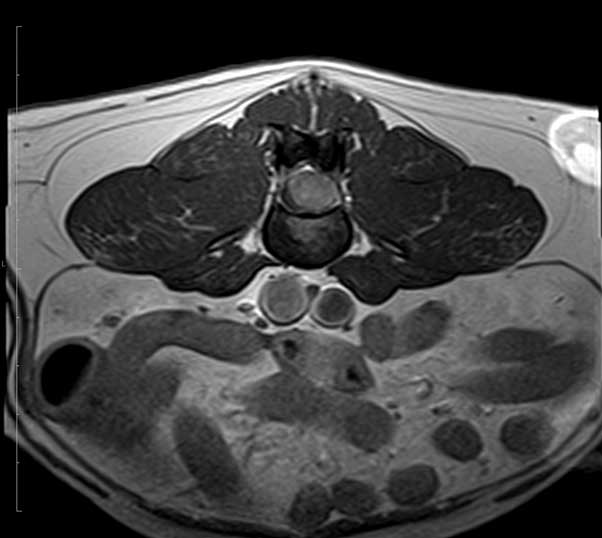 A T1-weighted post-contrast transverse scan revealing marked compression of the cord.