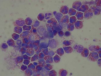 Figure 4. The strongly eosinophilic nature of the inflammation was confirmed on bronchoalveolar lavage fluid cytology. Note the ciliated epithelial cells in the centre confirming the site of sampling. Image: A Torrance, Torrance Diamond Diagnostic Services