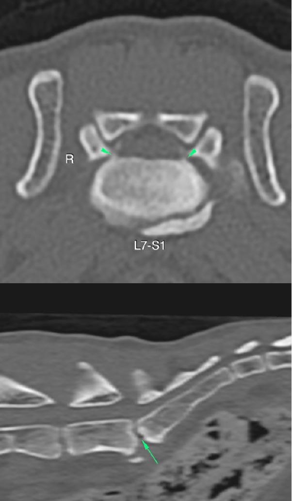 Figure 4. CT scan images showing osteophytes narrowing the intervertebral foraminae (green arrowheads) and narrowing of the lumbosacral disc space (green arrow).