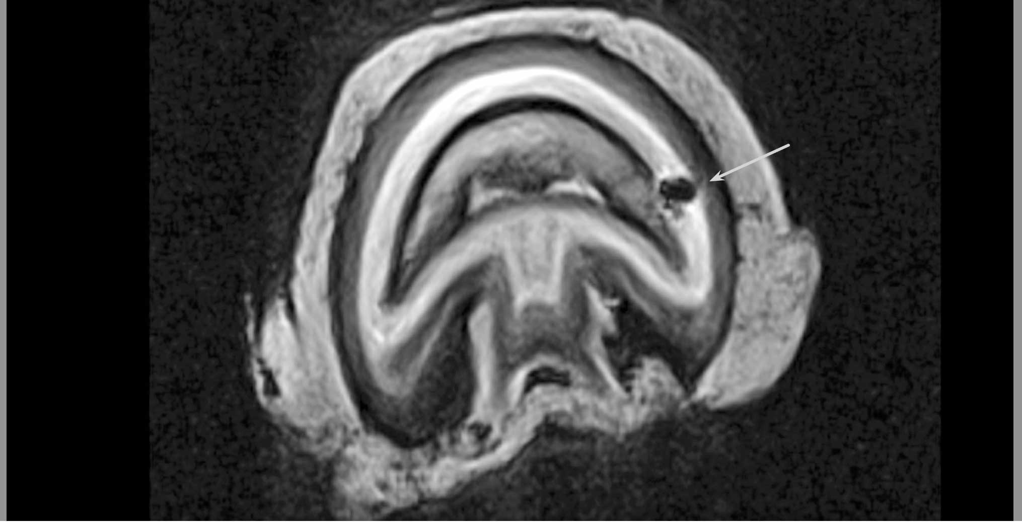 Figure 3. T1-weighted 3D transverse MRI showing area of hypointensity (arrow) in lateral aspect of the distal phalanx in horse with septic pedal osteitis. Image: University of Liverpool