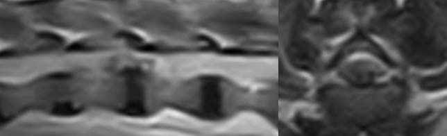 Figure 1. T2‑weighted sagittal and transverse MRI images demonstrating a T13-L1 intervertebral disc extrusion causing marked compression of the spinal cord.