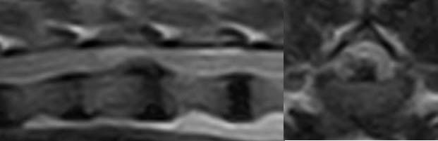 Figure 2. T2‑weighted sagittal and transverse MRI images following 12 weeks of conservative management of a T13-L1 intervertebral disc extrusion.