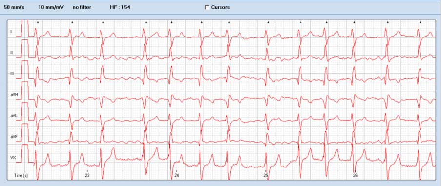 Figure 4. This canine ECG shows a heart rate of 165 bpm. No P waves are visible on any limb lead. The rate is fast and the rhythm is irregular. This is consistent with atrial fibrillation (50 mm/s and 10 mm/mV). There was right axis deviation present (MEA +140˚).
