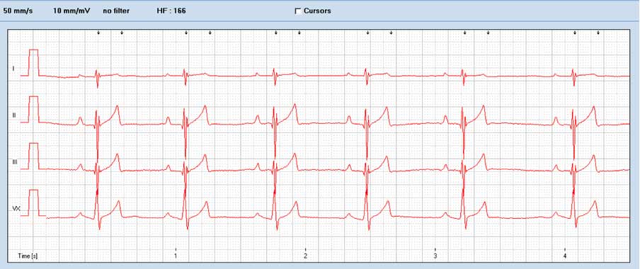 Figure 5. A canine ECG with sinus rhythm (50 mm/s and 10 mm/mV) Note the small size of R waves and deep S waves in lead I, II and III. Right axis deviation is also present (+135).
