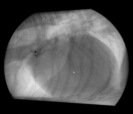 Figure 7. An Amplatz canine duct occluder placed in a patent ductus arteriosus in a canine.