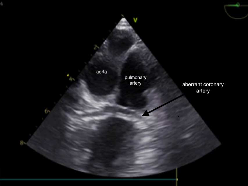 Figure 3. Transoesophageal echocardiography presenting with a type R2A anomaly of the coronary artery in a canine patient.