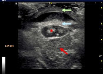 Figure 10. Endophthalmitis. In this image, the posterior segment is filled with echogenic foci caused by the presence of inflammatory cells (red arrow). Ultrasonographically, this may appear very similar to diffuse haemorrhage. Additionally, an echogenic area is present within the lens, representing a cataract (asterisk). Inflammatory infiltrates are present within the anterior chamber, creating a layer of echogenic material. This has adhered to the anterior lens capsule and obscures the iris (blue arrow). The cornea is thickened, showing loss of the ultrasonographic layering we would expect to visualise (green arrow).