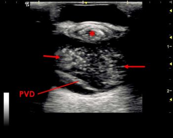 Figure 9. In this image, asteroid hyalosis can be seen as multiple echogenic foci within the vitreous chamber (between the red arrows). The lens shows signs of a mature cataract with increased echogenicity of the lens tissue and decreased lens volume (asterisk). Posterior vitreal detachment (PVD) is present, appearing as a hyperechoic line in the posterior vitreous chamber. The ultrasonographic appearance of a PVD is very similar to a retinal detachment and it may not be possible to distinguish between the pathologies; however, a detached retina would normally remain connected to the optic disc (see Figure 13).