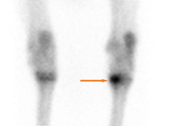 Figure 2. Scintigraphy appearance (arrow) of OA of the right distal tarsal joints of the same horse.