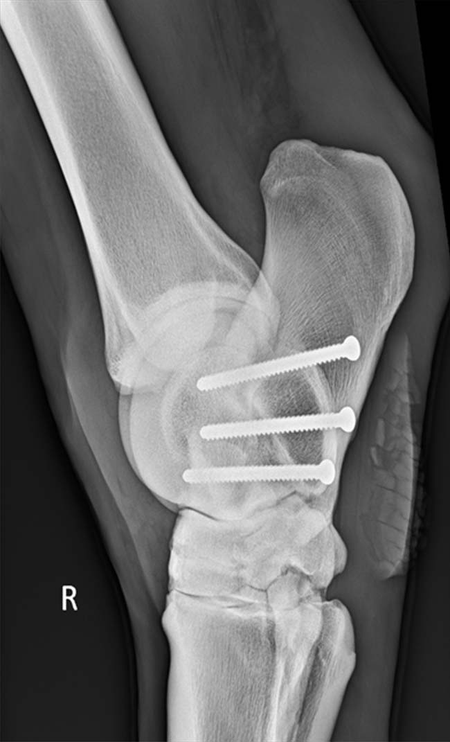 Figure 3. Surgical arthrodesis of the talocalcaneal joint using three cortical screws placed in lag fashion.