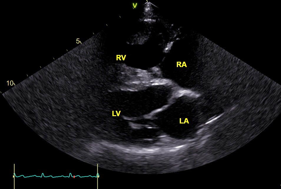 An echocardiogram image showing the right side of Snoob’s heart enlarged as a consequence of severe pulmonic stenosis. 