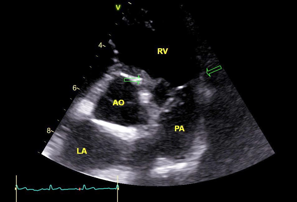 An echocardiogram image showing the leaflets of the pulmonic valve fused, causing narrowing outflow – the feature of pulmonic stenosis.
