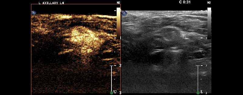 A left axillary lymph node example.
