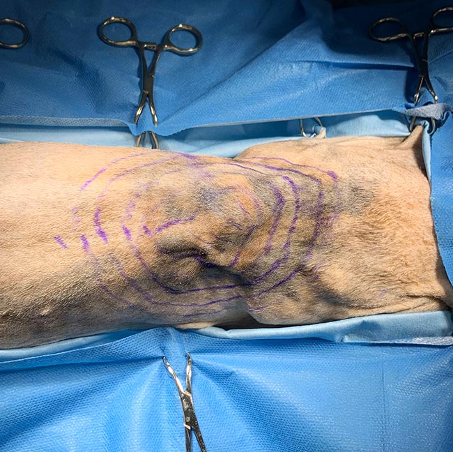 Figure 3. Several margins can be marked out using a skin pen before starting surgery.