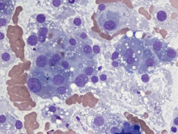 Figure 2. Fine needle aspirate from liver mass in a dog (50×).