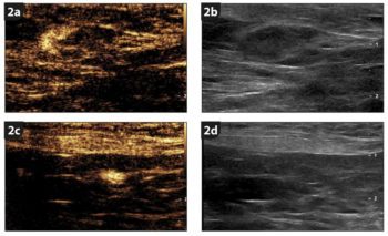 Figure 2. Left inguinal (2a and 2b) and medial iliac (2c and 2d) lymph nodes seen on normal ultrasound (2b and 2d) and seen on a specific contrast mode revealing the uptake of contrast (2a and 2c). The contrast was injected around the primary tumour and travelled through lymphatics before accumulating into the two draining lymph nodes. The left inguinal lymph node has a heterogeneous pattern (2a, overt metastasis), while the left medial iliac lymph node has a more homogeneous pattern (2c, overt metastasis).