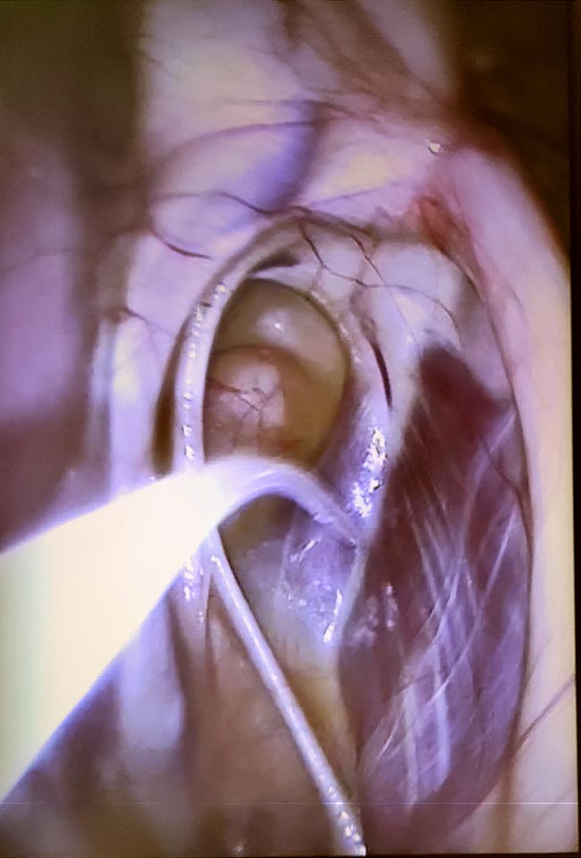 A catheter inside the guttural pouch.